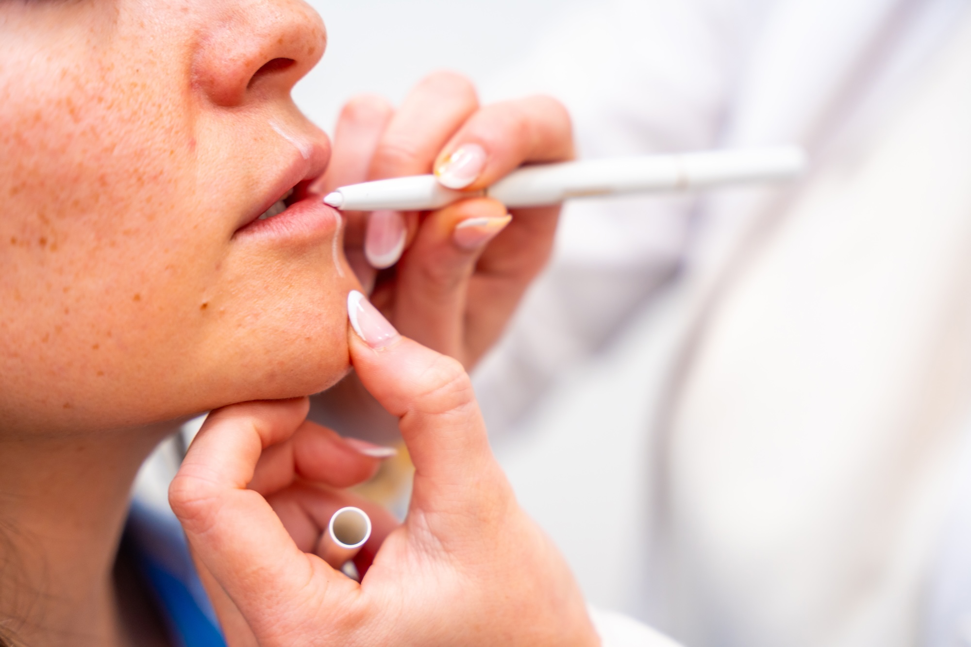Provider at Vive Aesthetics & Wellness marking the lips of a patient before injecting lip filler near Medford, NJ.